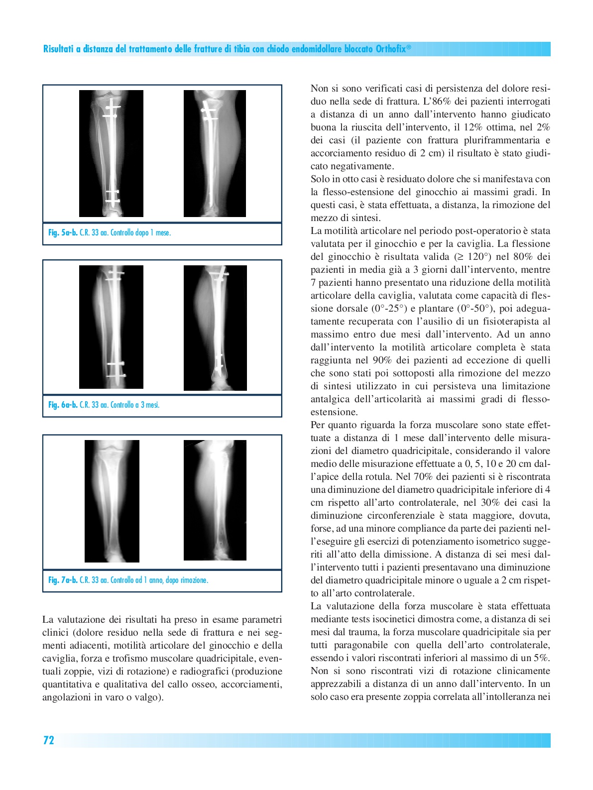 Articolo Giornale Italiano di Ortopedia e Traumatologia