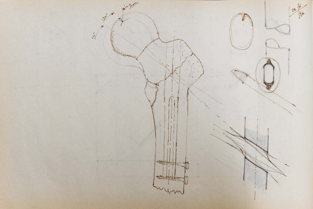 Disegno chiodi endomidollari del femore